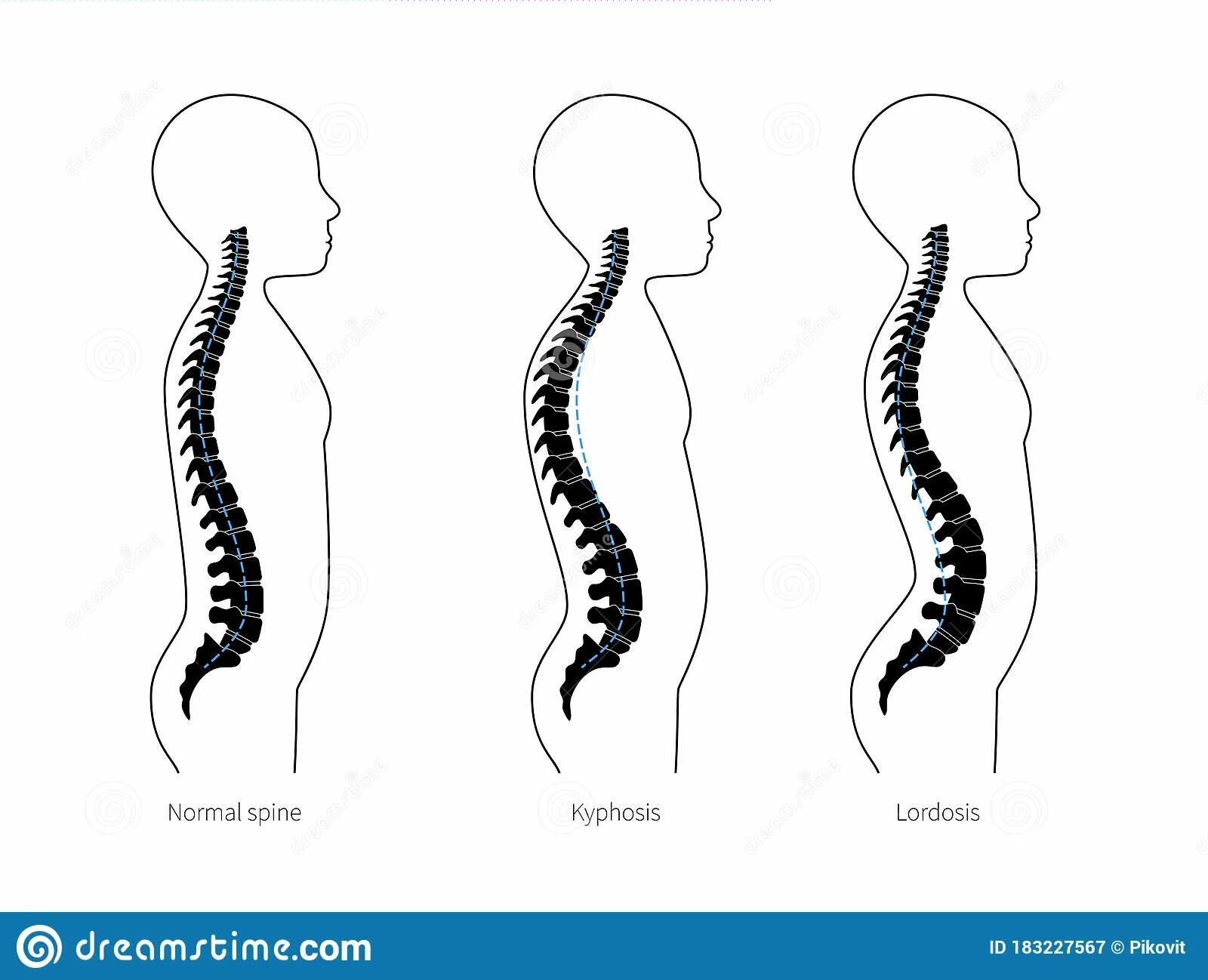 Щенок по имени лордоз. Лордоз и кифоз позвоночника. Искривление позвоночника лордоз. Лордоз кифоз сколиоз. Кифоз + лордоз поясничного отдела позвоночника.