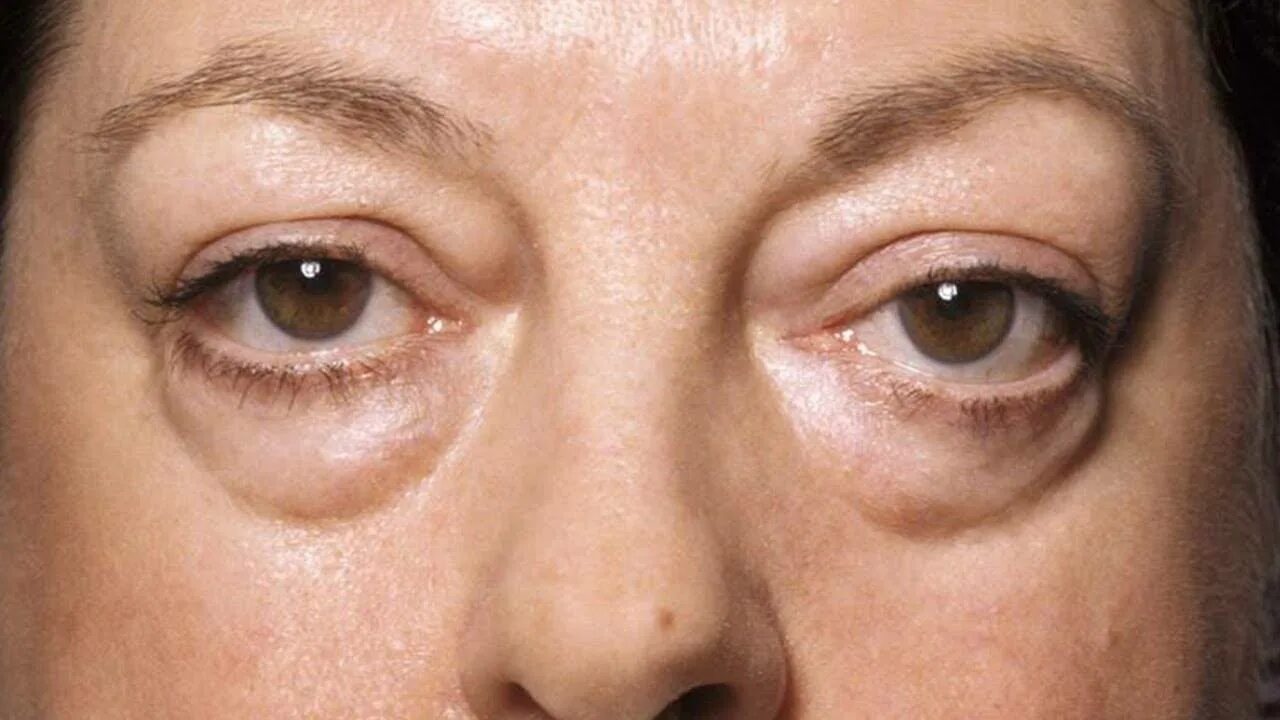 Отекшие глаза причины и лечение у женщин. Мешки под глазами. Огромные мешки под глазами.