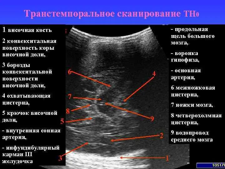 Расширение субарахноидального конвекситального пространства. Жидкость по конвекситальной поверхности. Узи головы в 2 месяца ребенку норма. Контузионные очаги на кт. Исследование спинномозговой жидкости норма у новорожденных.