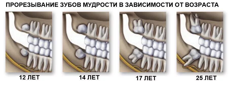 Прорезавшиеся зубы мудрости. Этапы прорезывания зубов мудрости. Когда вырастают зубы мудрас. Сколько зубов мудрости может быть у человека