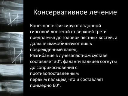 Консервативное лечение переломов