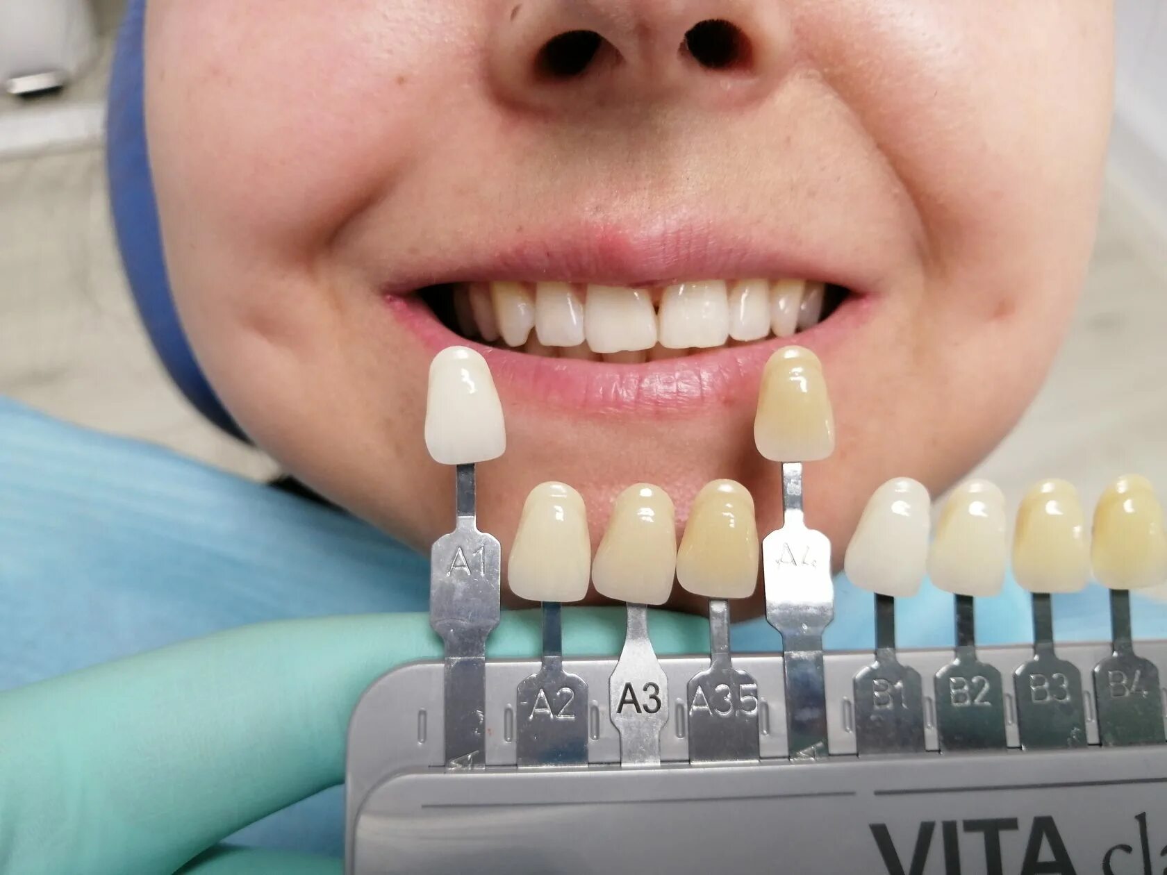 Палитра стоматология. Шкала Вита цветов зубов а2. А2 а3 шкала Вита. Оттенок а2 зубов по шкале Вита. Шкала Vita (шкала Вита, VITASCALE).