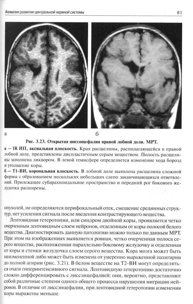 Субатрофические изменения мозга. Атрофия лобных долей мрт. Шизэнцефалия мрт. Кистозно-атрофические изменения головного мозга на кт. Желудочки головного мозга в теменной области.