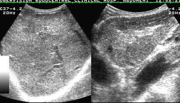 Жировой гепатоз печени на УЗИ. Жировая дистрофия печени на УЗИ. Локальная жировая дистрофия печени на УЗИ. Очаговый жировой гепатоз на УЗИ. Эхоструктура диффузная поджелудочная железа