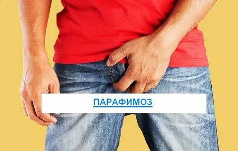 Парафимоз у мужчин