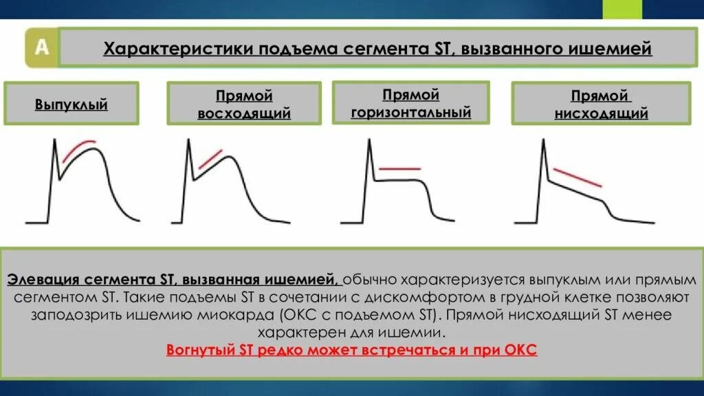 Причины подъема. Вогнутая элевация сегмента St. Горизонтальная элевация сегмента St. Сегмент St. Депрессия и элевация сегмента St.