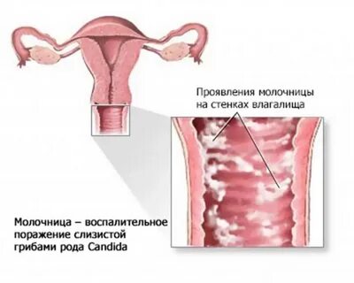 laurenaspyn КАНДИДОЗ. laurenaspyn НАРОДНЫЕ. laurenaspyn СРЕДСТВА. 