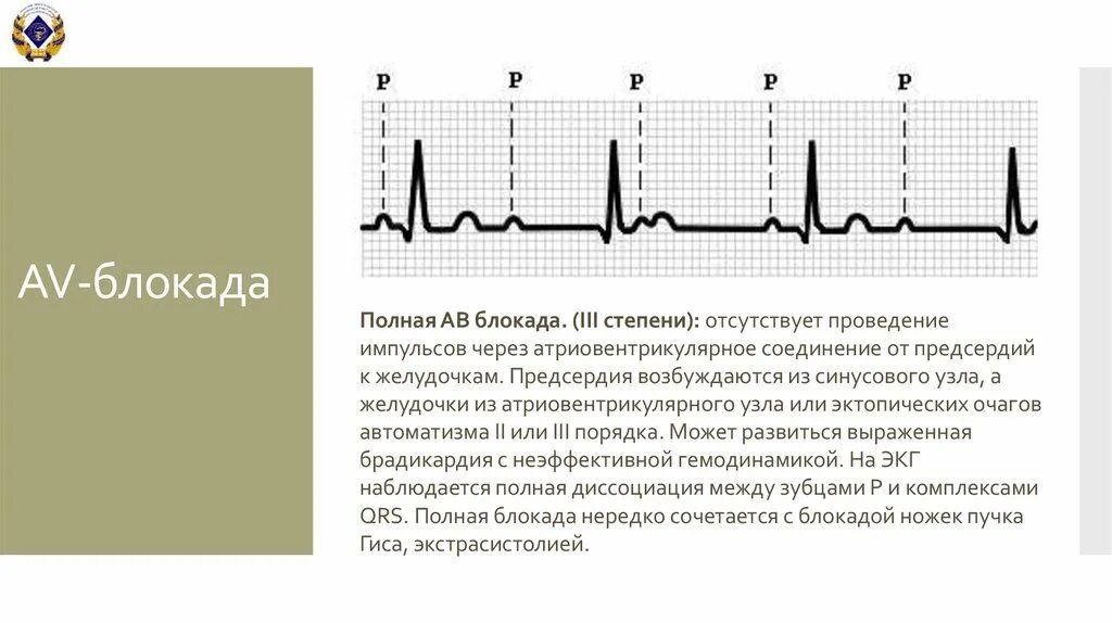 Как часто делают блокаду. АВ блокада 2 степени собака. Са блокада 3 степени на ЭКГ. ЭКГ АВ блокада 3 заключение. Дифференциальная диагностика при АВ блокада 2 степени.