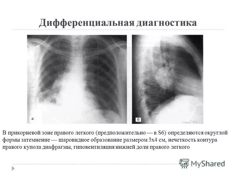 образование верхней доли правого легкого. объемные образования в легких на кт. периферическое образование нижней доли правого лёгкого. образование нижней доли правого легкого. периферическое образование правого легкого.