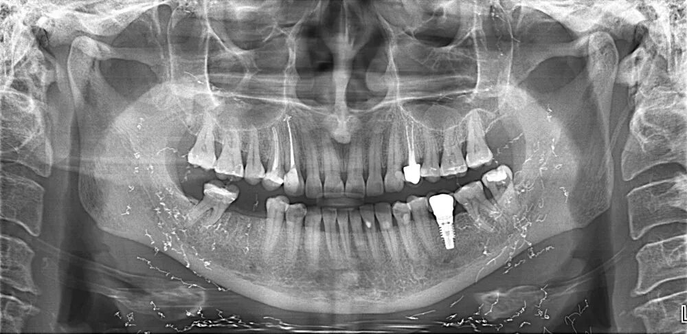 Снимок зубов видное. Ортопантомограмма кариес. Ортопантомограмма пародонтит. Ортопантомограмма челюсти. Ортопантомограмма периодонтит.