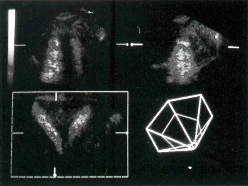 Мультиплоскостное УЗИ. УЗИ мультиплоскостное расщелина. Трехмерная эхография глаза книга. Задний свод матки