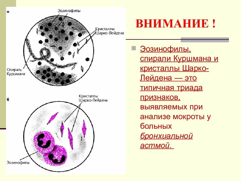 Мокрота астматика