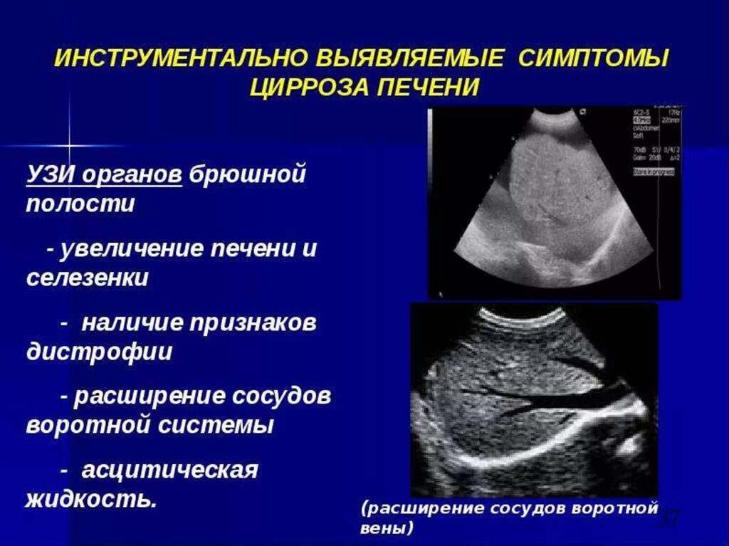Инструментальные методы печени. Узи признаки цирроза. Узи признаки цирроза. Узи признаки цирроза печени. Портальная гипертензия на узи.