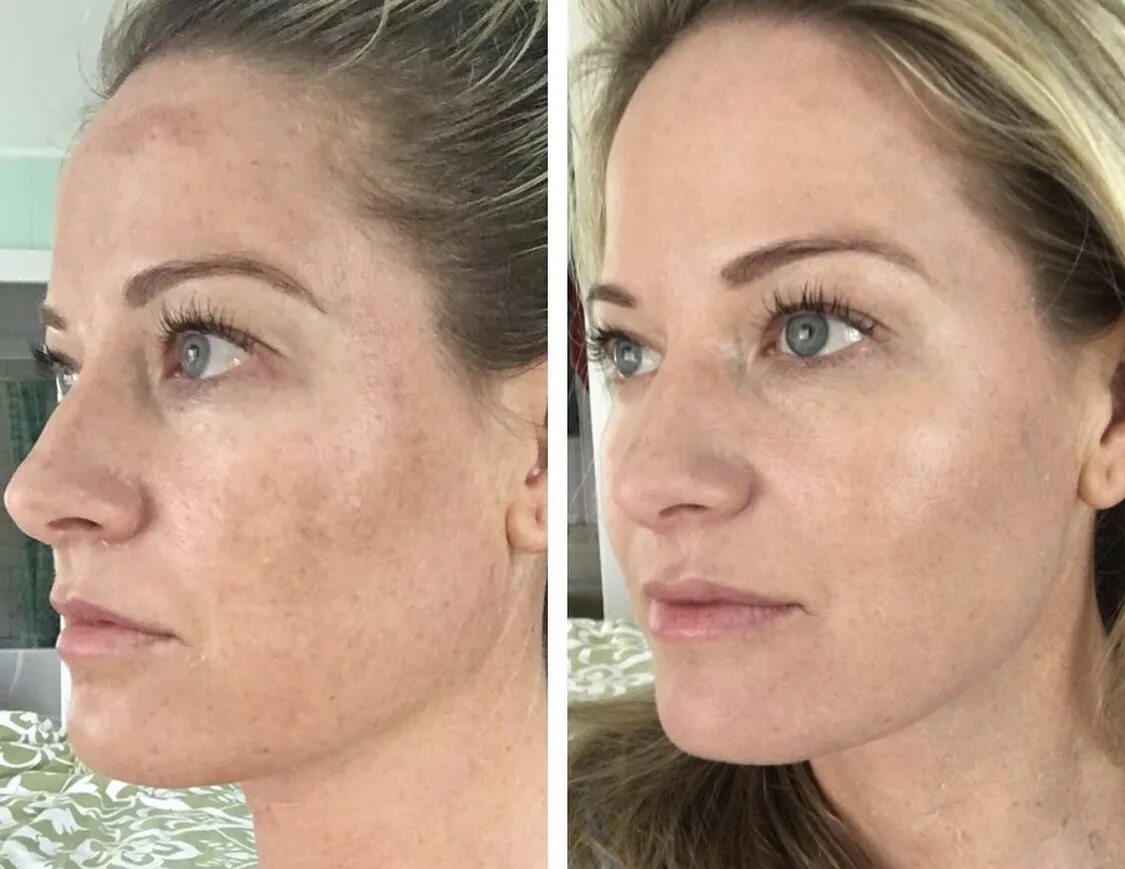 Можно ли делать пилинг во время. Можно ли делать пилинг во время. Пилинг джесснера постакне. Срединный пилинг джесснера. Лазерный карбоновый пилинг для лица до и после.