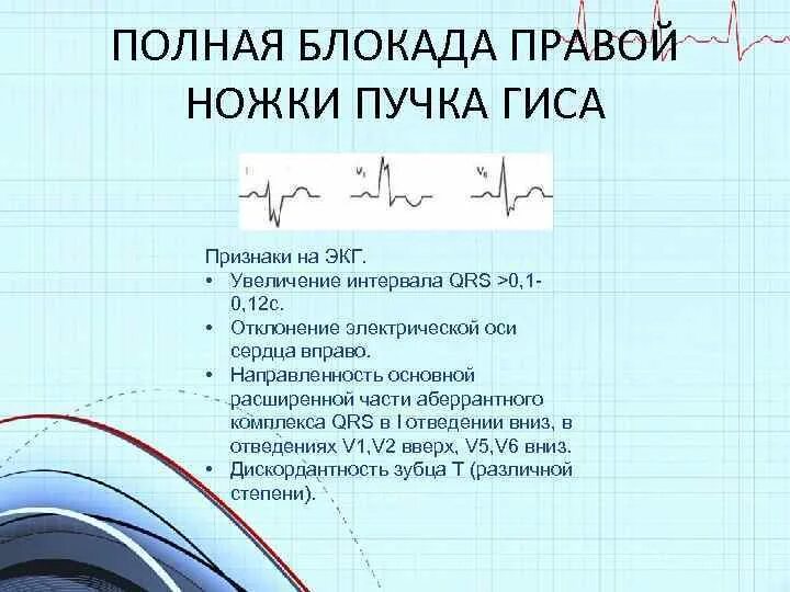 Признаки неполной блокады. Признаки полной блокады правой ножки пучка Гиса. Блокада ПНПГ на ЭКГ признаки. ЭКГ-критерий полной блокады правой ножки пучка Гиса:. ЭКГ полная блокада правой ножки пучка.