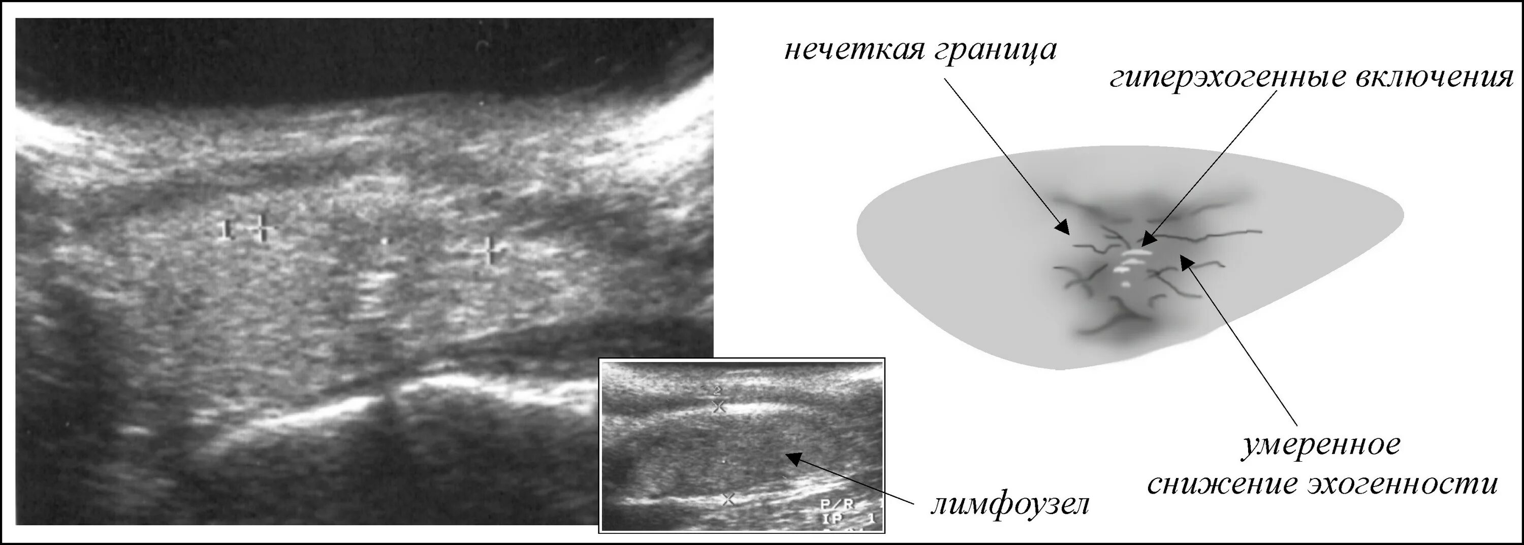 Поджелудочная диффузно повышенной эхогенности. Лимфатический узел щитовидной железы УЗИ. Шкала эхогенности УЗИ. Узлы щитовидной железы пониженной эхогенности. Эхогенность снижена УЗИ щитовидная железа.
