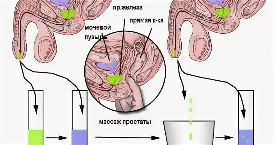 Исследование секрета предстательной железы. Забор секрета предстательной железы. Исследование сока простаты. Массаж предстательной железы. Предстательная железа сок