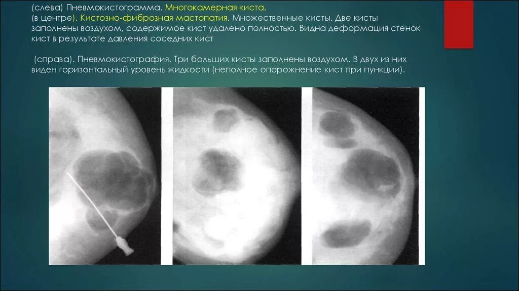 Киста молочной железы фиброзная мастопатия. Фиброзная мастопатия молочных желез рентген. Диффузная фиброзно-кистозная мастопатия рентген. Фиброзно-кистозная мастопатия на кт. Фиброаденоматоз bi