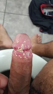 More pictures of smegma reddit.