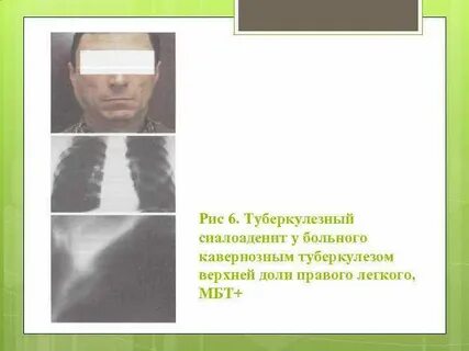 6 туберкулезная