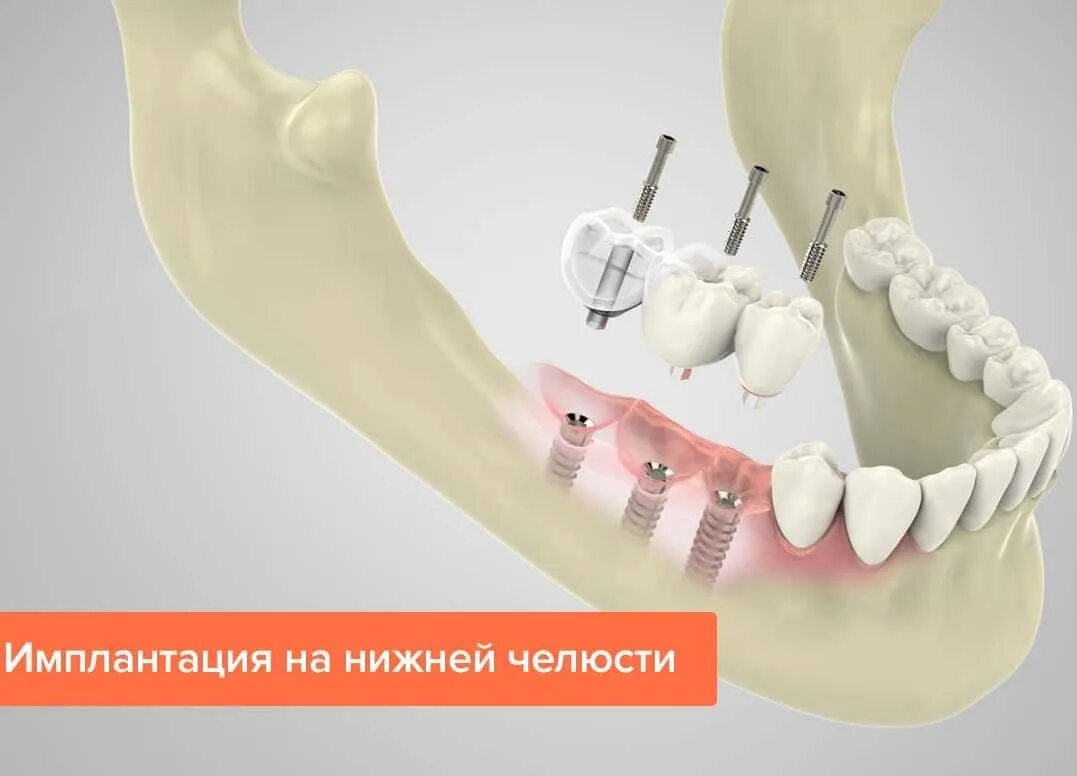 Установка акриловых протезов в Рязани