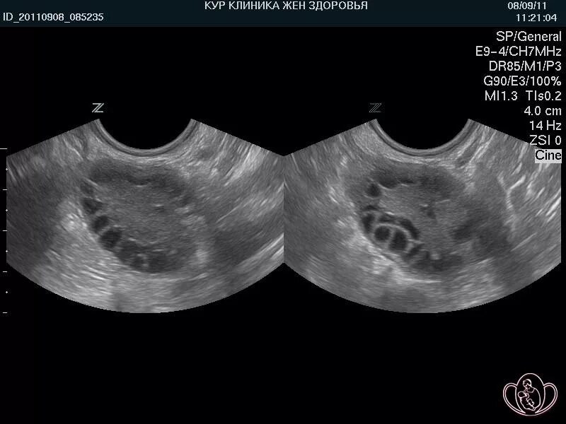 УЗИ яичников доминантный фолликул. Яичники на УЗИ норма. УЗИ малого таза яичники. Поликистоз яичников УЗИ малого таза. Киста яичника orads