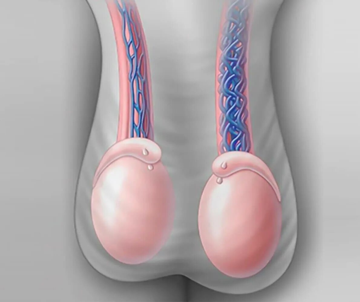 Варикоцеле семенного канатика. Варикозное расширение вен семенного канатика. Варикоцеле – расширение вен семенного канатика. Расширение вены семенного канатика