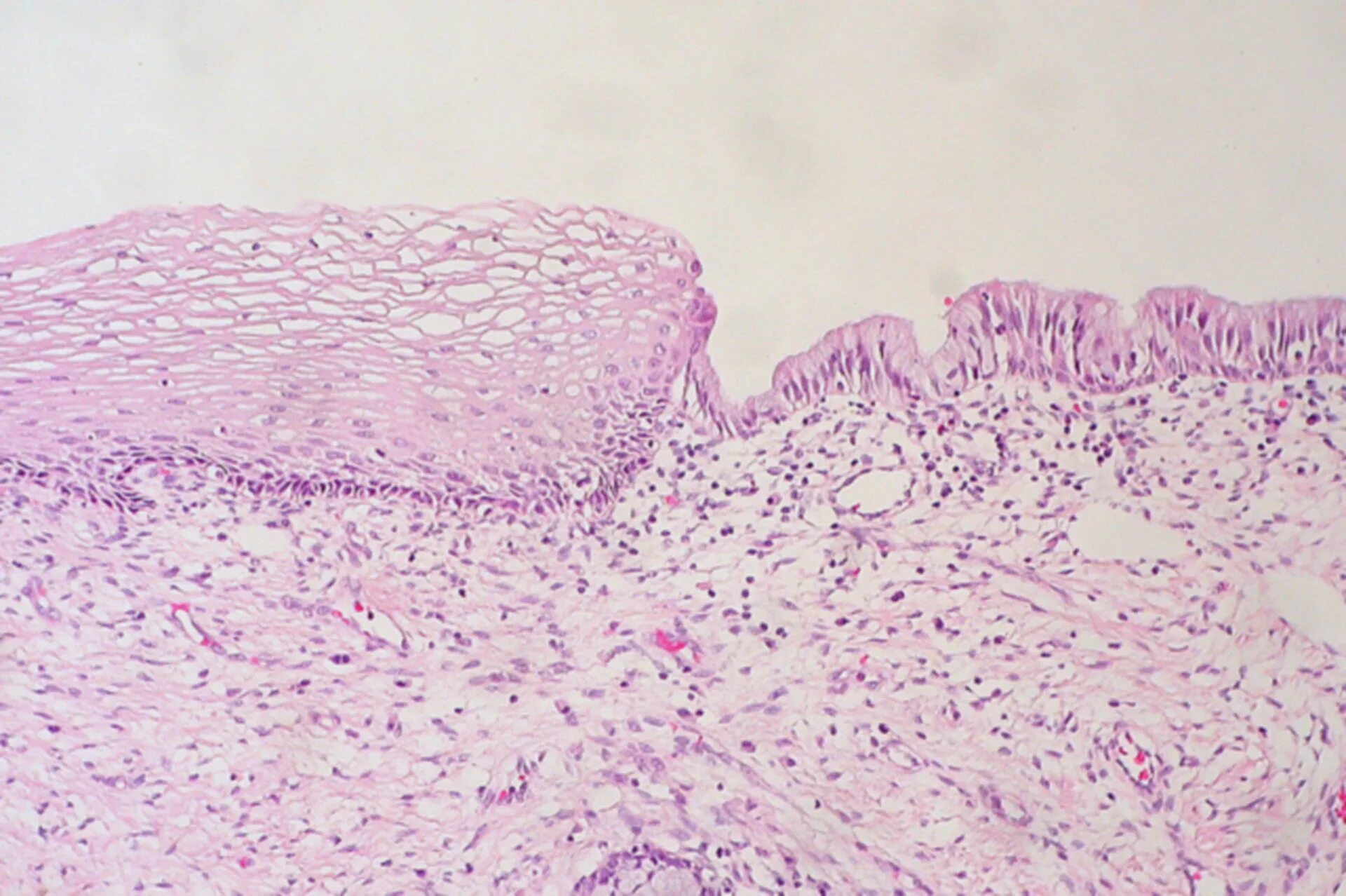 Эктопия цилиндрического эпителия. Многослойный плоский эпителий шейки матки гистология. Дисплазия шейки матки гистология. Переходная зона шейки матки гистология. Маточный эпителий.
