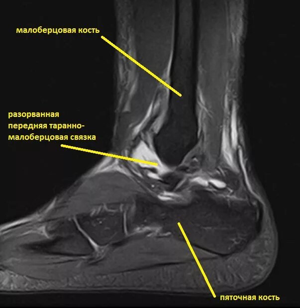 Капсульно-связочный аппарат голеностопного сустава. Таранная кость мрт анатомия. Мрт разрыв связок голеностопа. Разрыв дельтовидной связки голеностопного сустава рентген. Операция малоберцовой кости