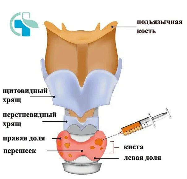 Щитовидная железа узлы в правой доле. Киста в щитовидной железе 5мм. Узлы и кисты щитовидной железы. Кистащетовидноижелезы. Щитовидная железа гисте.