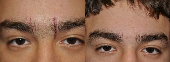 Брови мужские сросшиеся. Monobrow. Как избавиться от моноброви. Красивая форма мужских бровей. Мужские брови до и после коррекции.