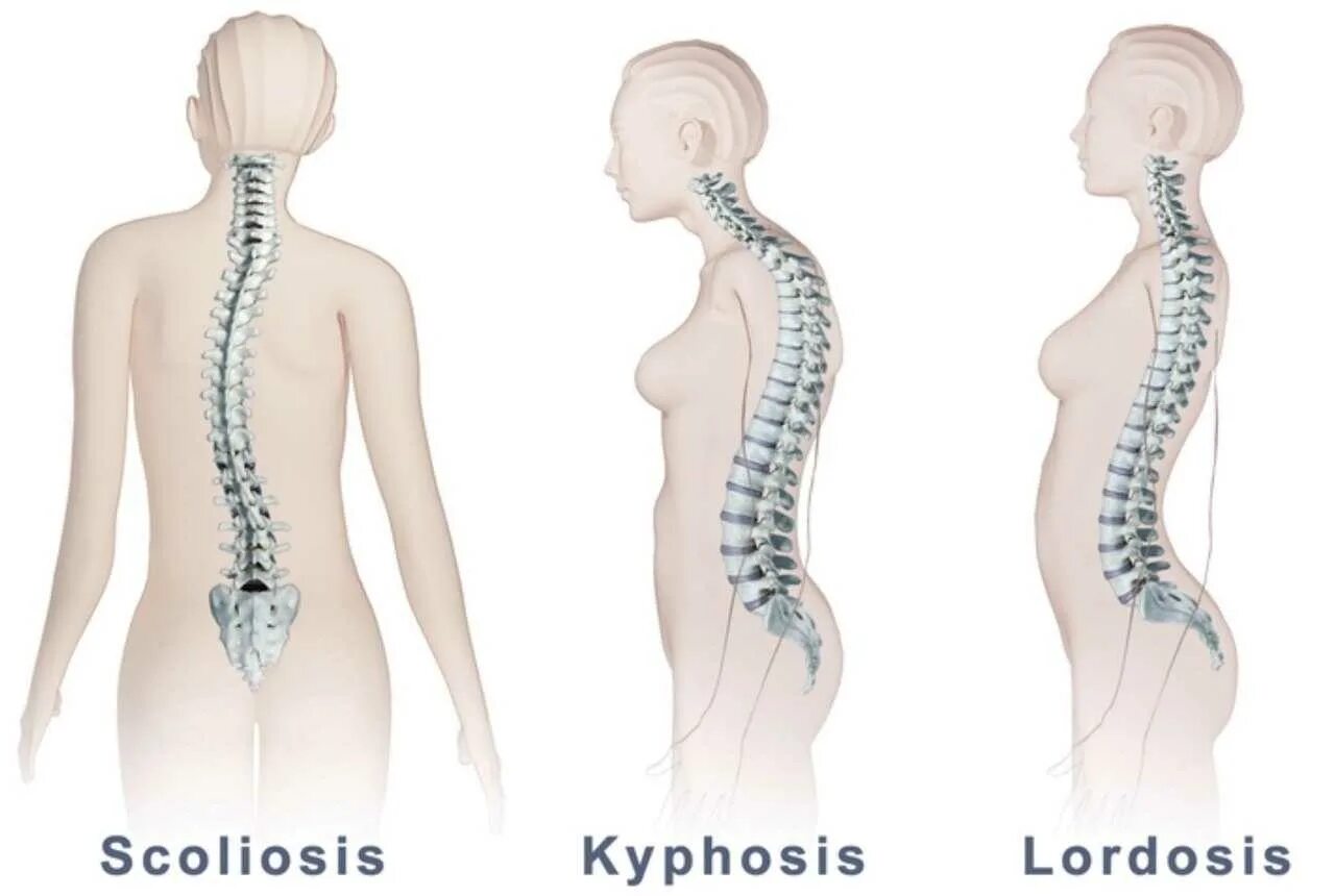 Кифоз и лордоз поясничного отдела. Деформации позвоночника кифоз лордоз сколиоз. Скелет позвоночника лордоз кифоз. Искривление грудного отдела позвоночника кифоз.