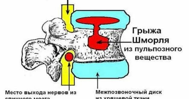 Грыжа мозговых оболочек освобождение нерва. Грыжа Шморля th5-th12. Шморля грыжа на позвоночнике l1-l2. L1 грыжа Шморля позвоночника.