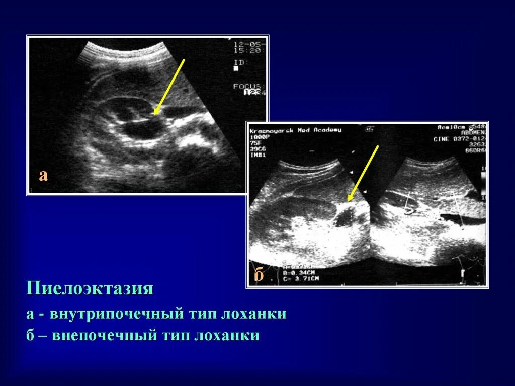 Расширение лоханки у ребенка. Расширение лоханки почки на УЗИ. Пиелокаликоэктазия почки на УЗИ. Расширенная почечная лоханка на УЗИ. Расширенная лоханка почки на УЗИ.