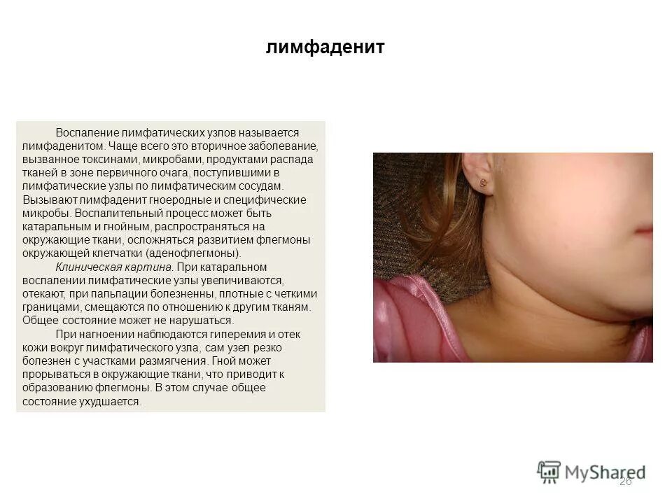 Гиперплазия лимфоузлов у детей. Острый Гнойный шейный лимфаденит. Острый серозный подчелюстной лимфаденит. Воспаление лимфатических узлов называется.