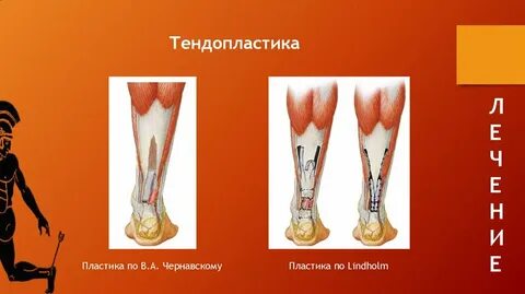 Ахиллопластика