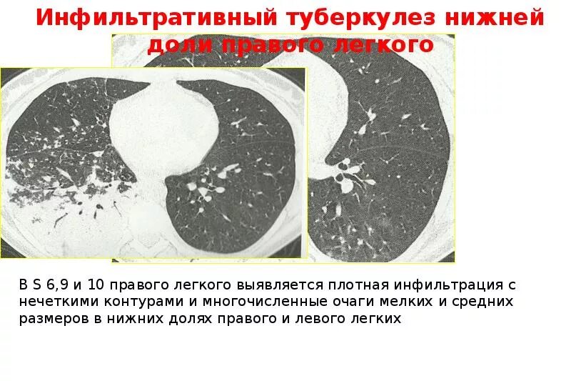 Очаги в нижней доле легкого. Инфильтративный туберкулез легких кт. Инфильтративный туберкулез на кт. Инфильтрация на кт легких. Инфильтративный туберкулез нижней доли левого легкого.
