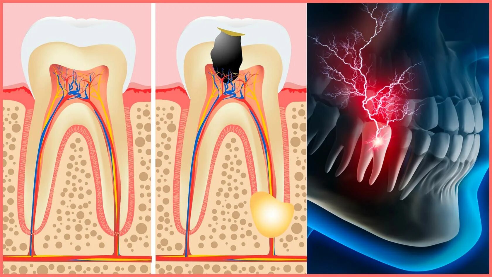 что такое периодонтит в стоматологии
