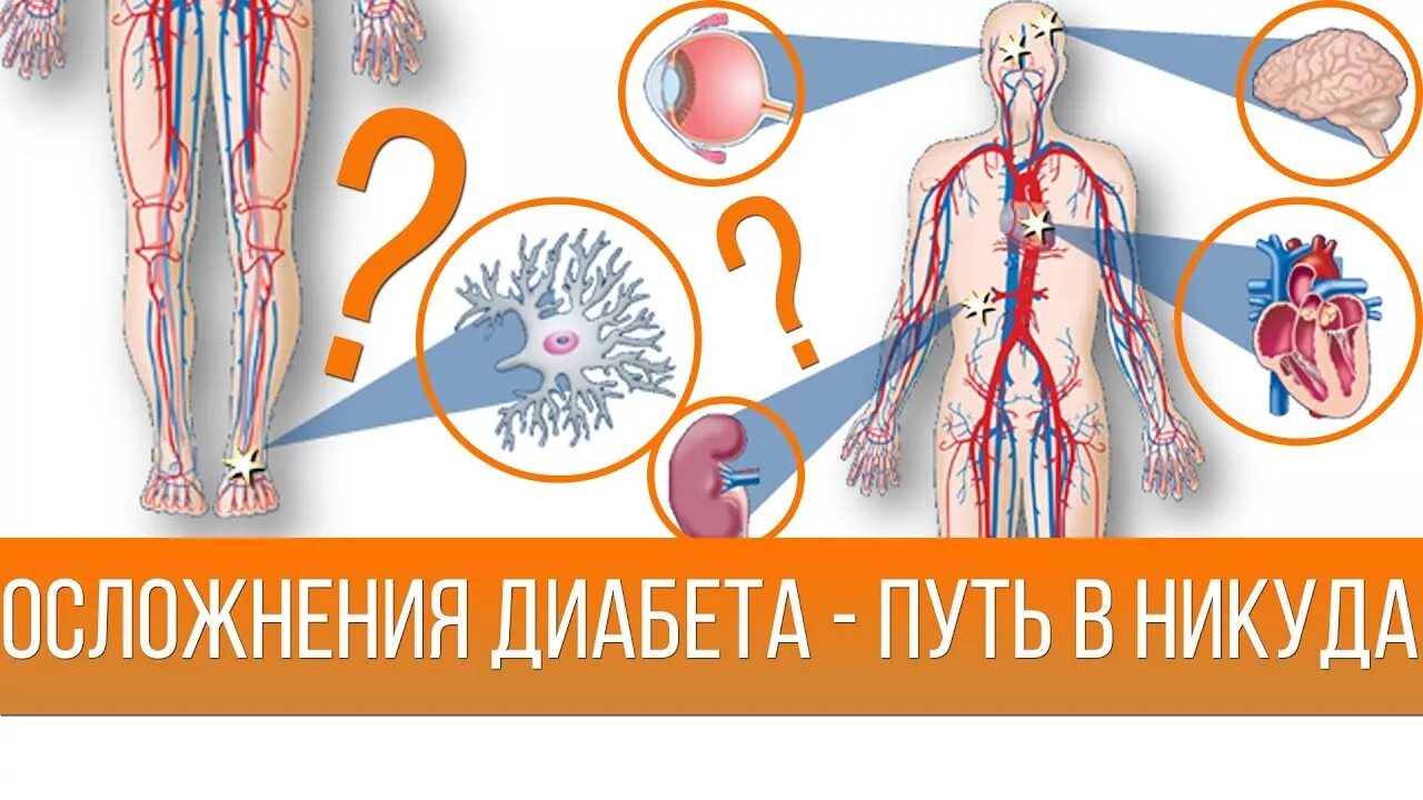 Осложнения сахарного диабета. Осложнения сахарного диабета картинки. Поздние осложнения сахарного диабета. Острые осложнения сахарного диабета. Ранние осложнения диабета