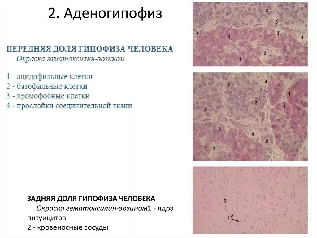 Базофильная аденома гипофиза гистология. Клетки аденогипофиза гистология. Нейрогипофиз гистология. Гипофиз гистология препарат. Базофильная аденома.