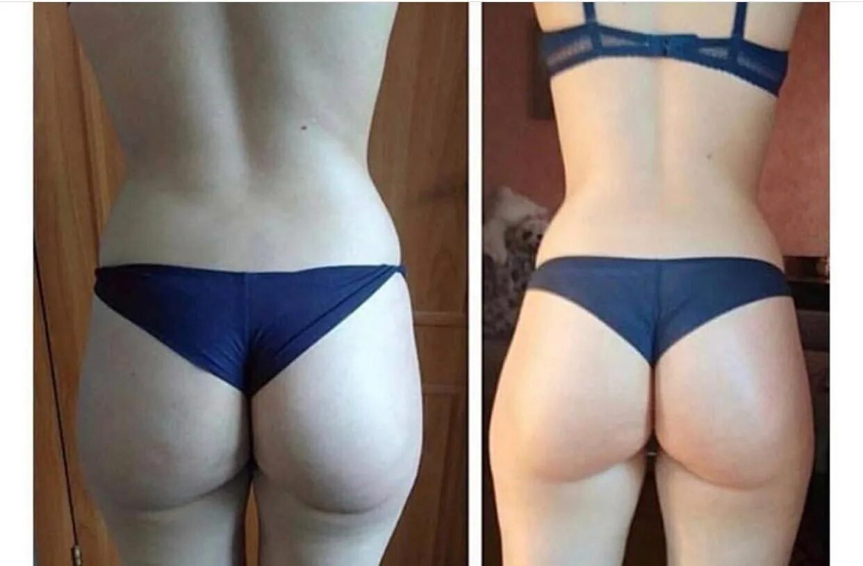 упражнения чтобы убрать складку под попой. Lpg массаж. идеальные ягодицы. как убрать под ягодицами. складка под попой.