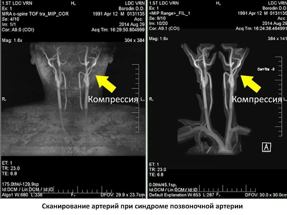 Мрт паническая атака. Синдром позвоночной артерии кт. УЗИ спазм позвоночной артерии. Синдром позвоночной артерии мрт. Аномалии отхождения позвоночной артерии.