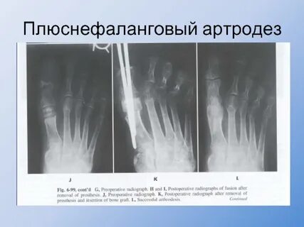Остеоартроз плюснефаланговых