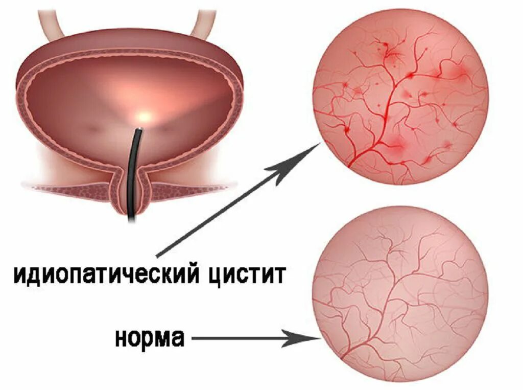 После лучевой цистит. Идиопатический цистит. Гнойное воспаление мочевого пузыря. Патогенез бактериального цистита.