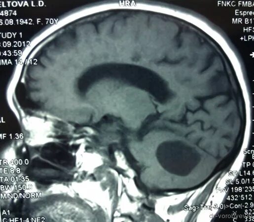 Арахноидальная киста мозжечка. Арахноидальная киста мозжечка кт. Арахноидальная киста мозжечка на мрт головного мозга. Опухоли задней черепной ямки на кт.