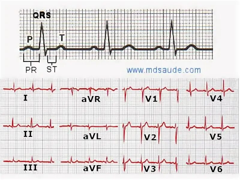 Комплекс QRS на ЭКГ. Двугорбый зубец р на ЭКГ. Электрокардиография зубцы QRS. Выпадение комплекса QRS на ЭКГ.