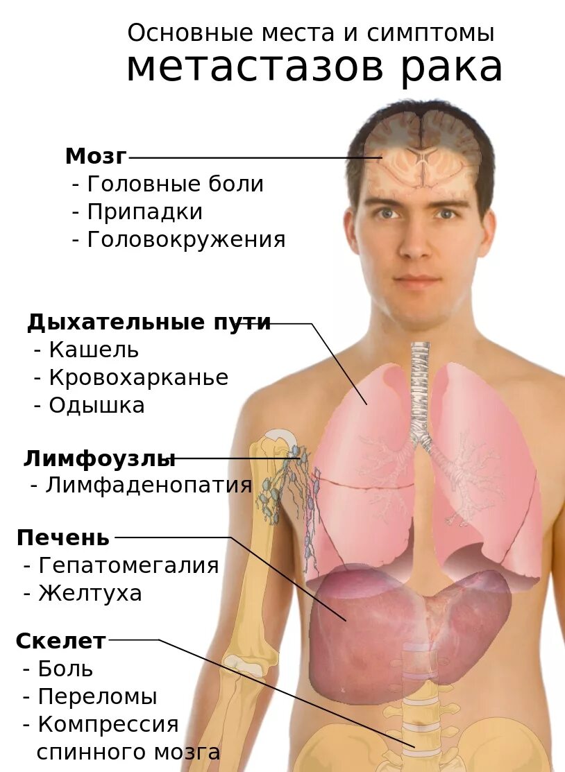 Какой рак метастазирует. Больные лёгкие симптомы.