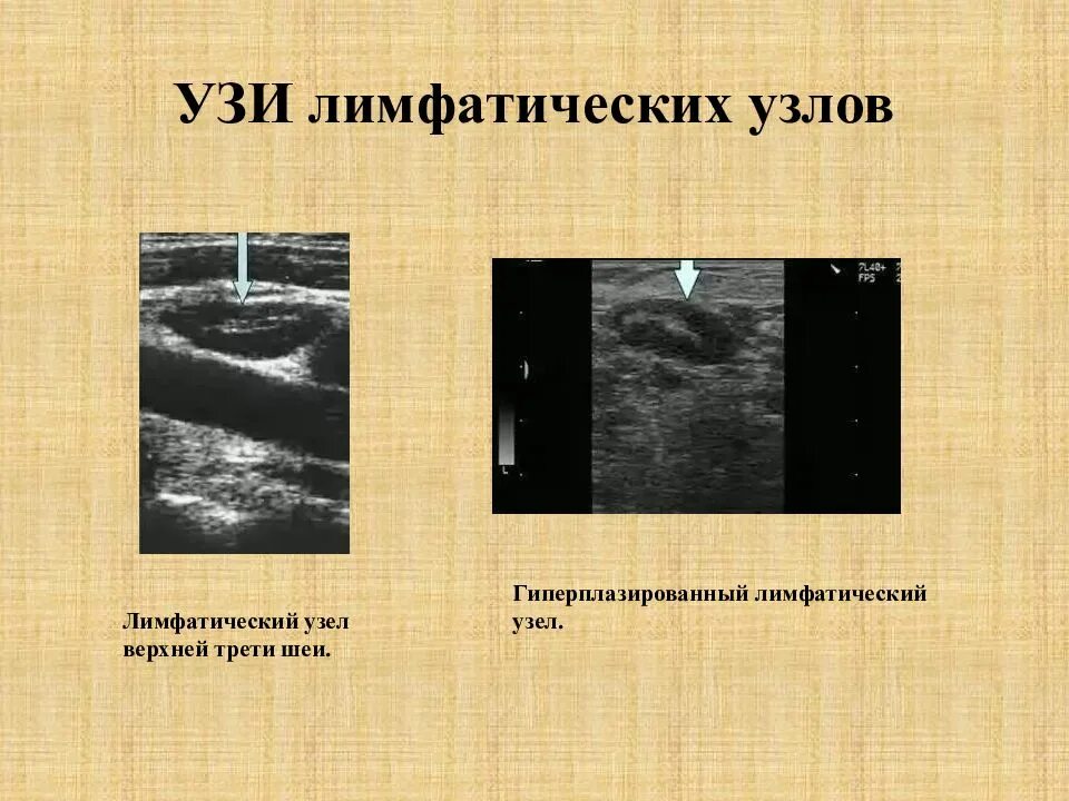 Описание лимфатических узлов на УЗИ. УЗИ лимфатических узлов норма. УЗИ лимфатических узлов шеи. Неоднородные лимфоузлы