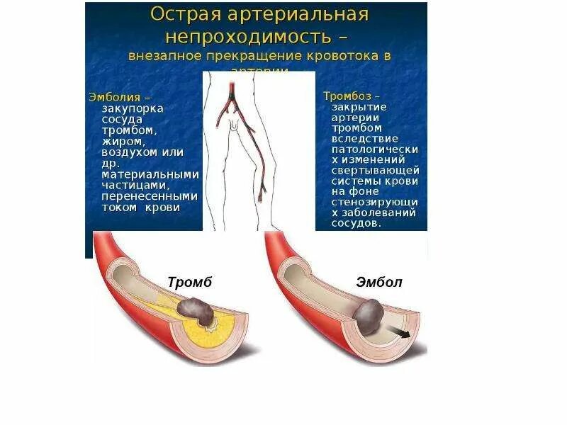 Острые тромбозы и эмболии магистральных артерий. Клиника острого тромбоза артерий нижних конечностей. Тромбоз и эмболия магистральных артерий. Острый тромбоз магистральных артерий. Звонкий сосуд