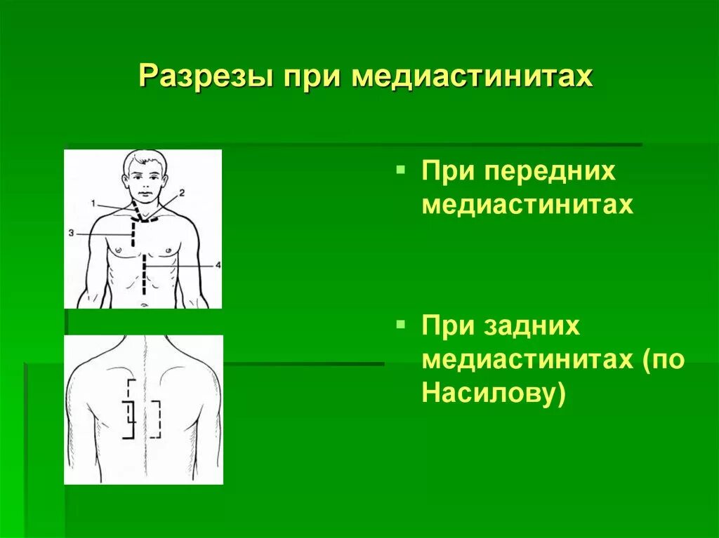 Медиастинит причины. Острый гнойный медиастинит. задняя медиастинотомия. разрезы при медиастините.